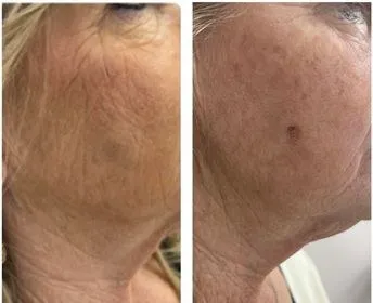 Cheek filler before and after