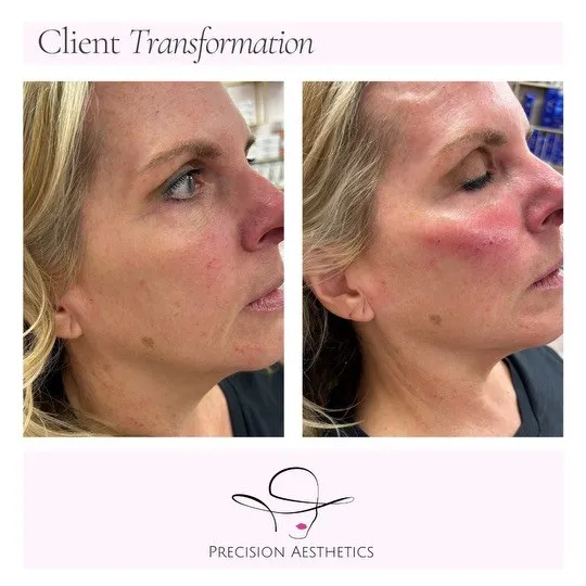 Client transformation before and after cheek filler