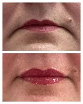 Mouth corners before and after DAO neurotoxin treatment