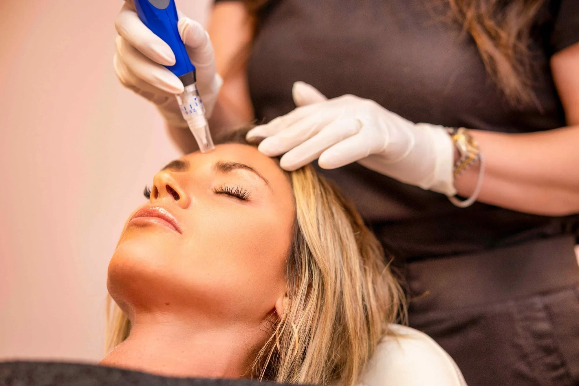 SkinPen microneedling treatment at Precision Aesthetics