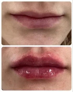 Lip filler before and after, front view