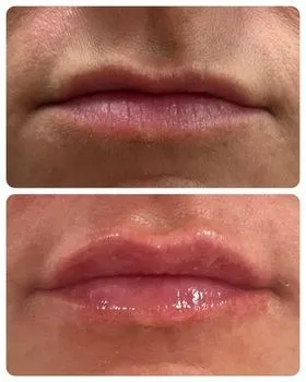 Lip filler before and after with added volume