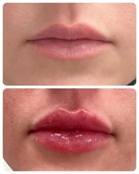 Lips before and after lip filler