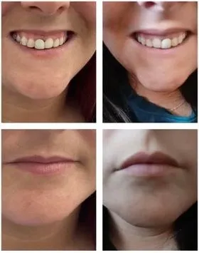 Smile before and after a lip flip