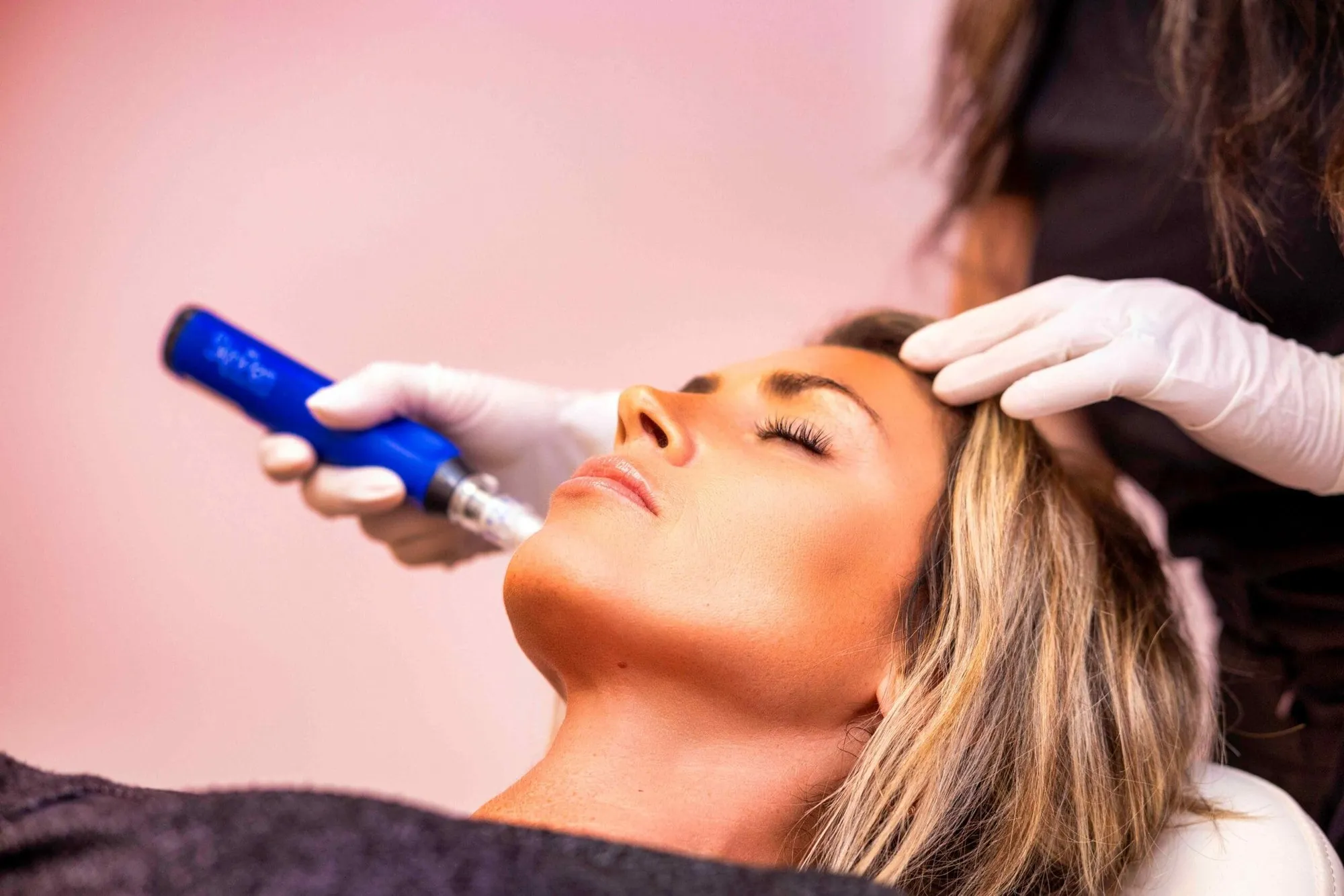 SkinPen microneedling treatment at Precision Aesthetics