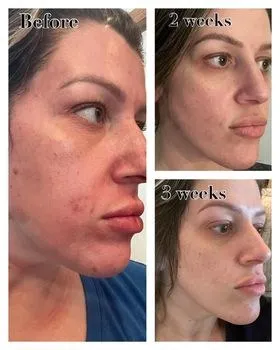Skin before, 2 weeks after, and 5 weeks after microneedling