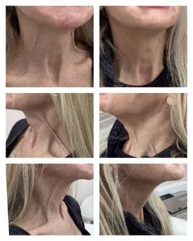 Neck before and after a neurotoxin neck lift