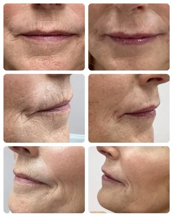 Perioral lines before and after dermal filler