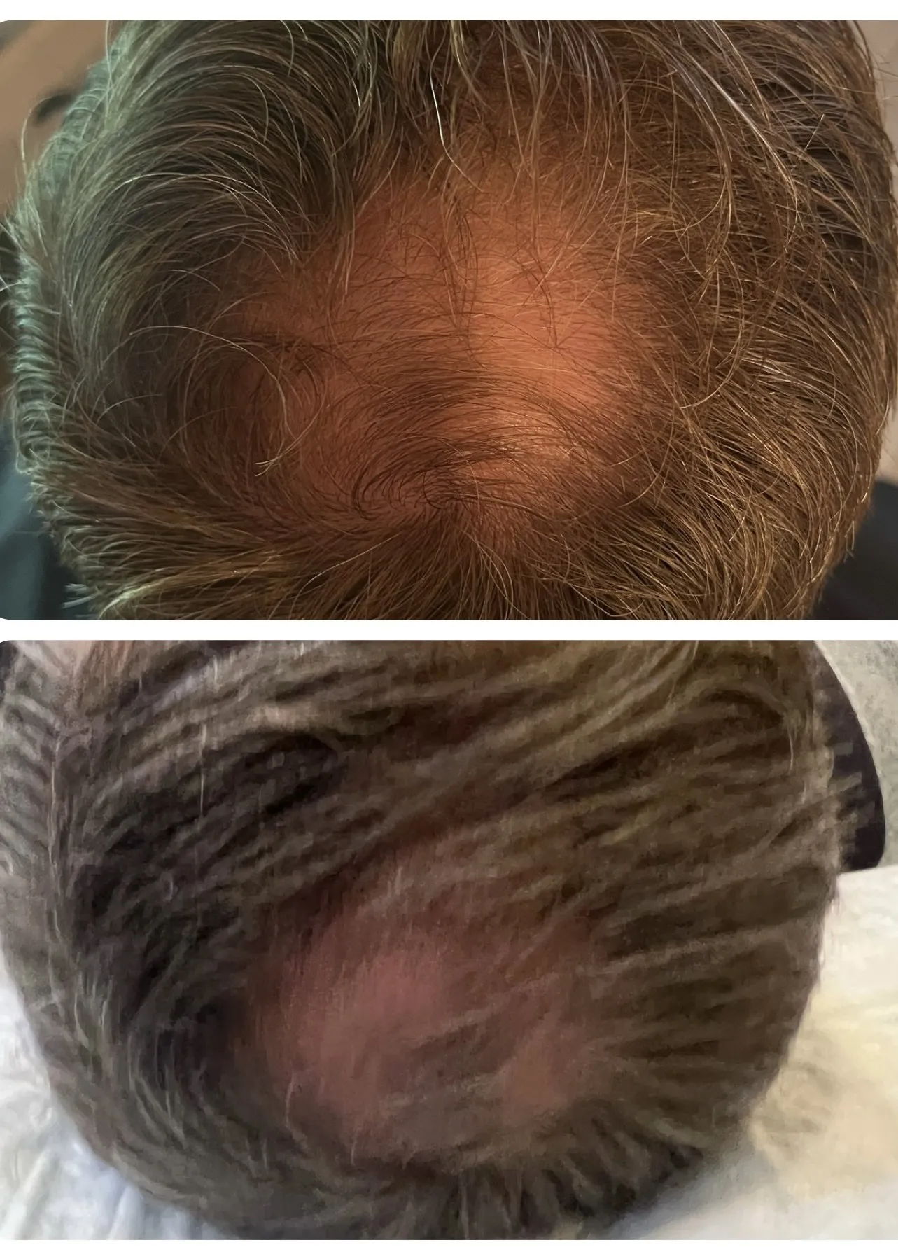 Scalp before and after PRP hair rejuvenation