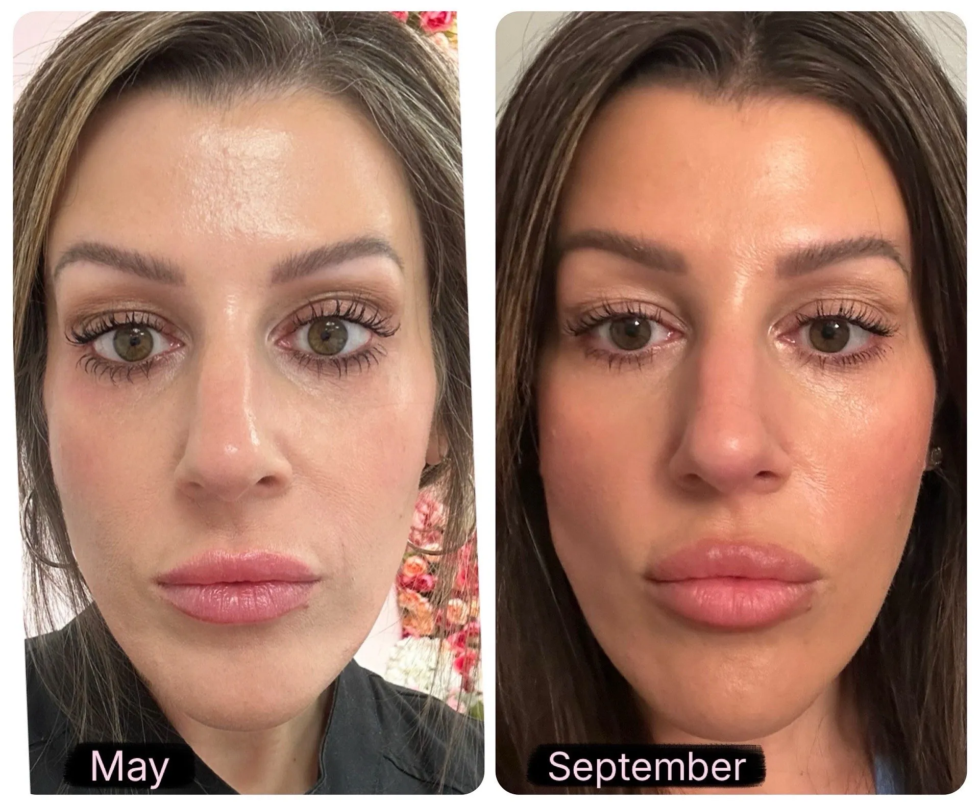 Client before (May) and after (September) Sculptra® treatment