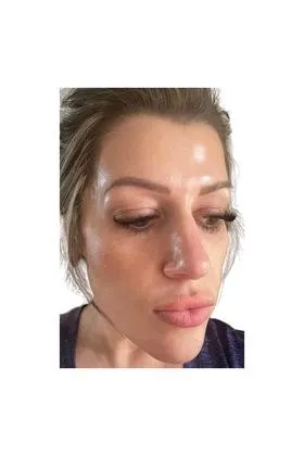 Glowing skin after a ZO Stimulator Peel