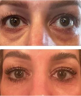 Under eyes before and after tear trough PRP
