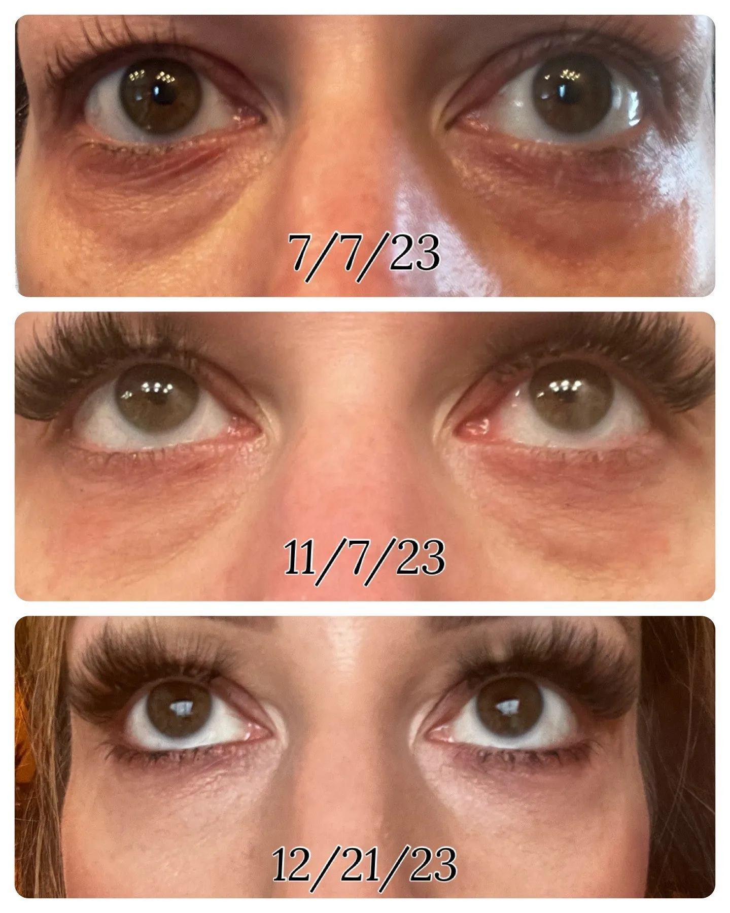 Under eyes at 7/7/23, 11/7/23 and 12/21/23 during tear trough PRP treatment