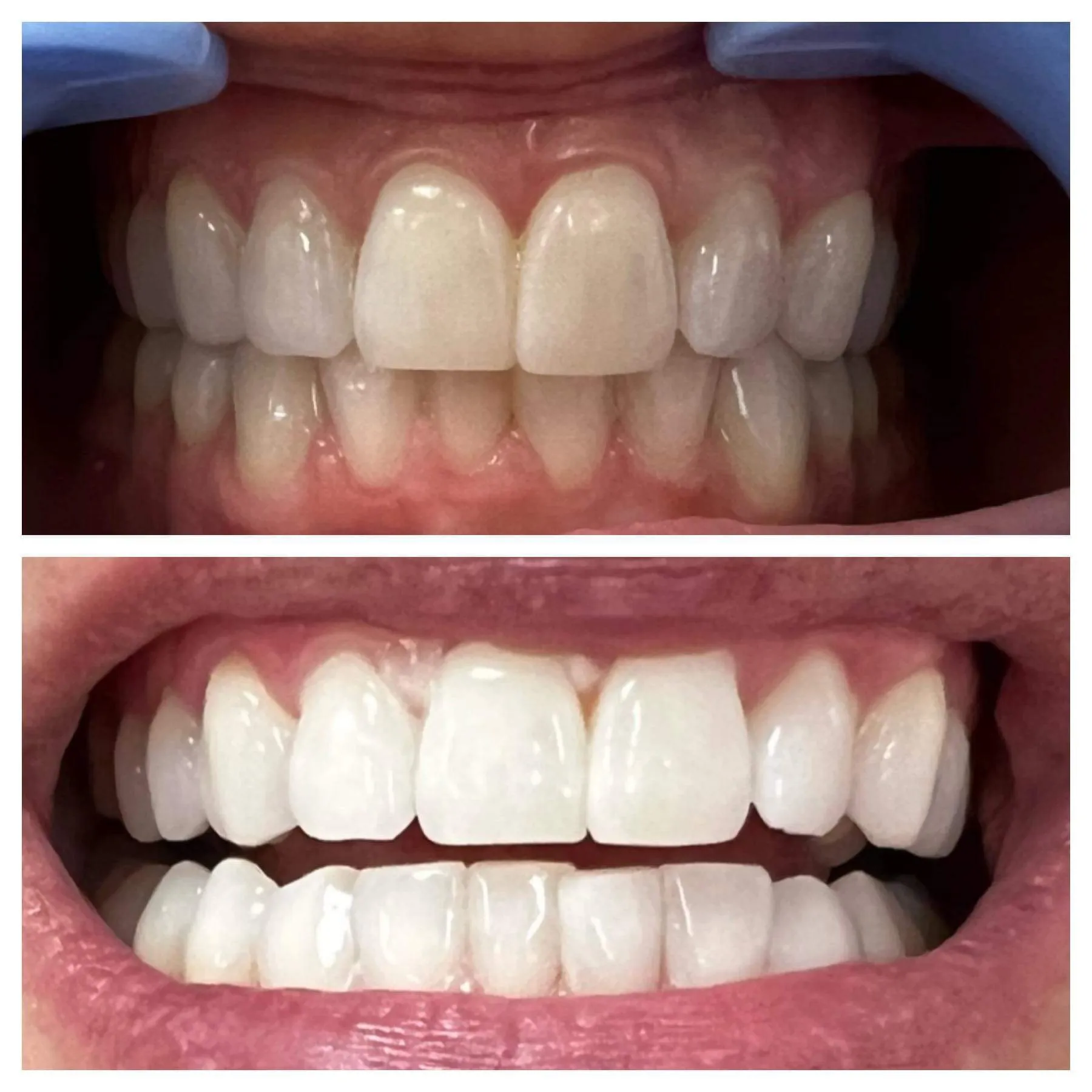 Teeth before and after whitening