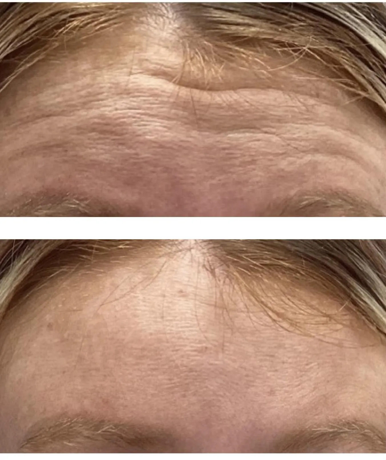 Forehead wrinkles before and after wrinkle release