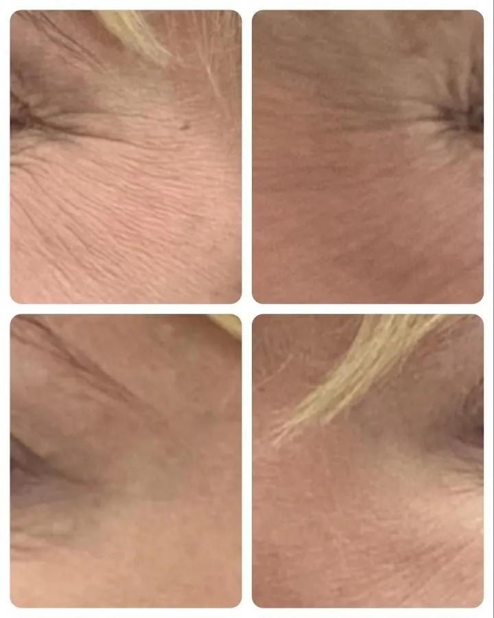 Fine lines before and after neurotoxin treatment