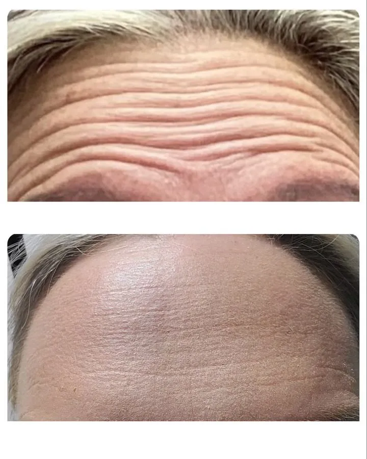 Forehead lines before and after neurotoxin treatment